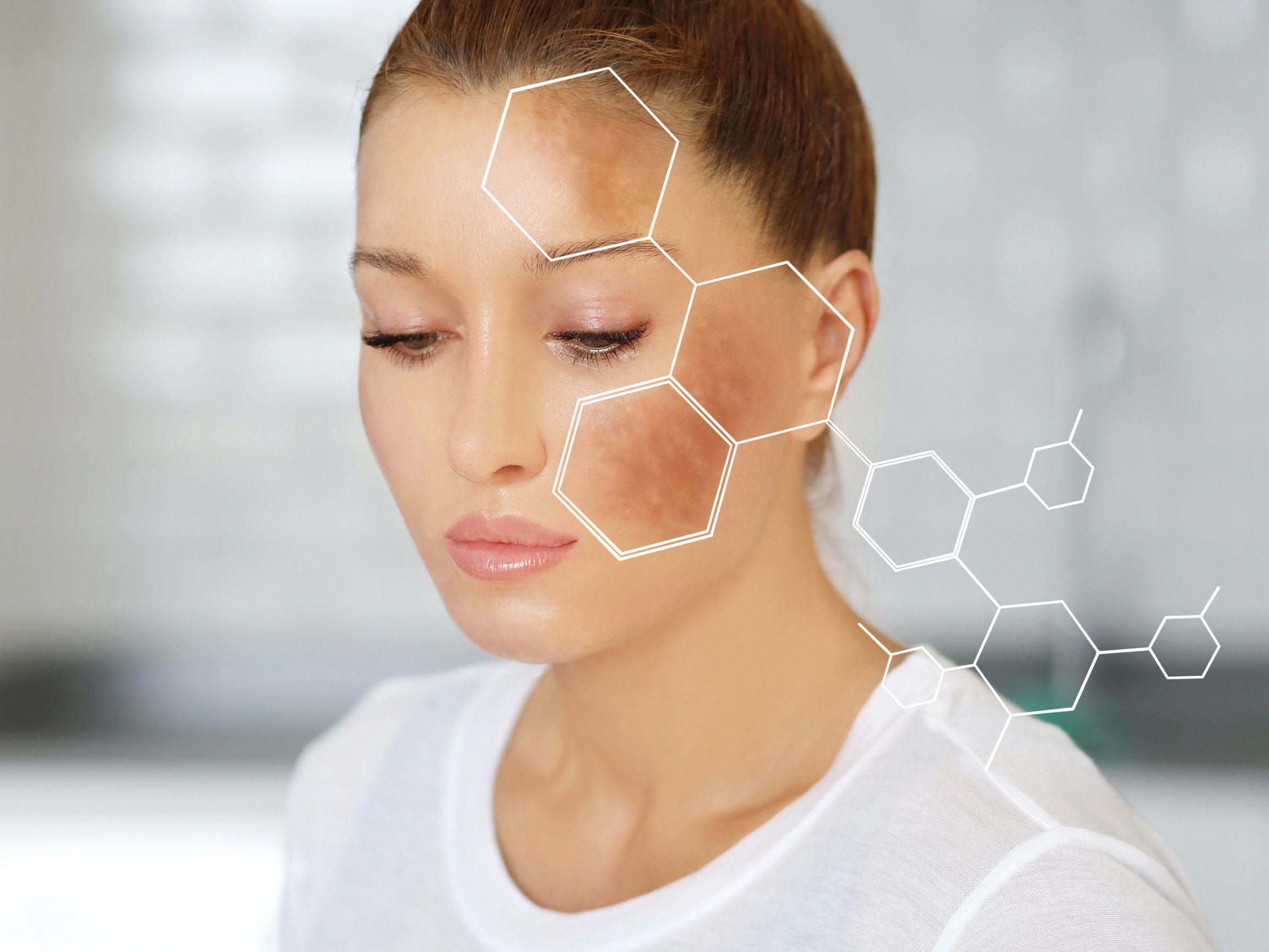 What’s the Best Treatment for Hyperpigmentation? Your Guide to Radiant Skin at Sol Skin Spa