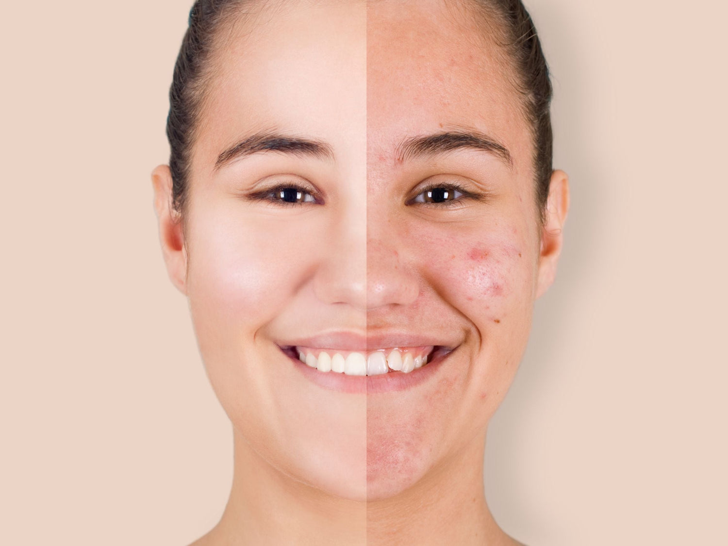 Acne Scar Treatment in Mississauga — How to Finally Get Rid of Acne Scars for Good