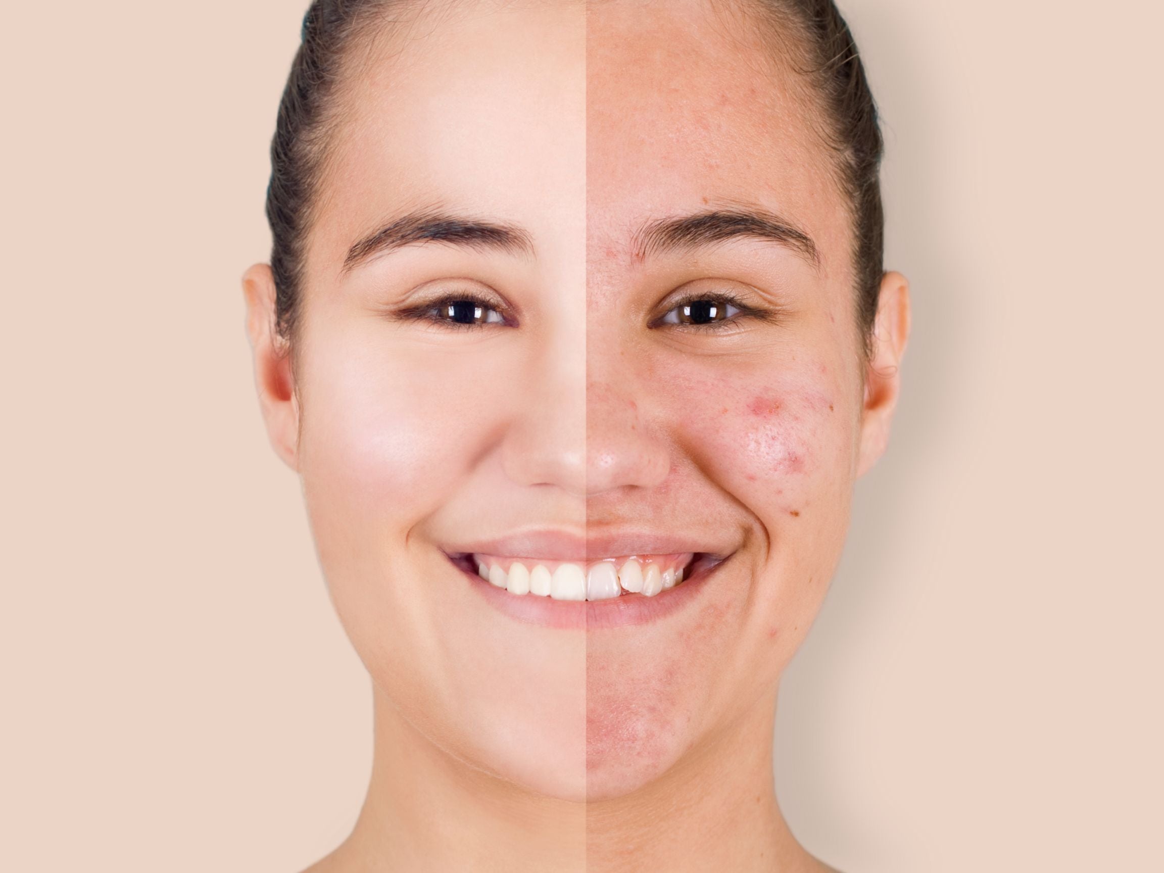 Acne Scar Treatment in Mississauga — How to Finally Get Rid of Acne Scars for Good