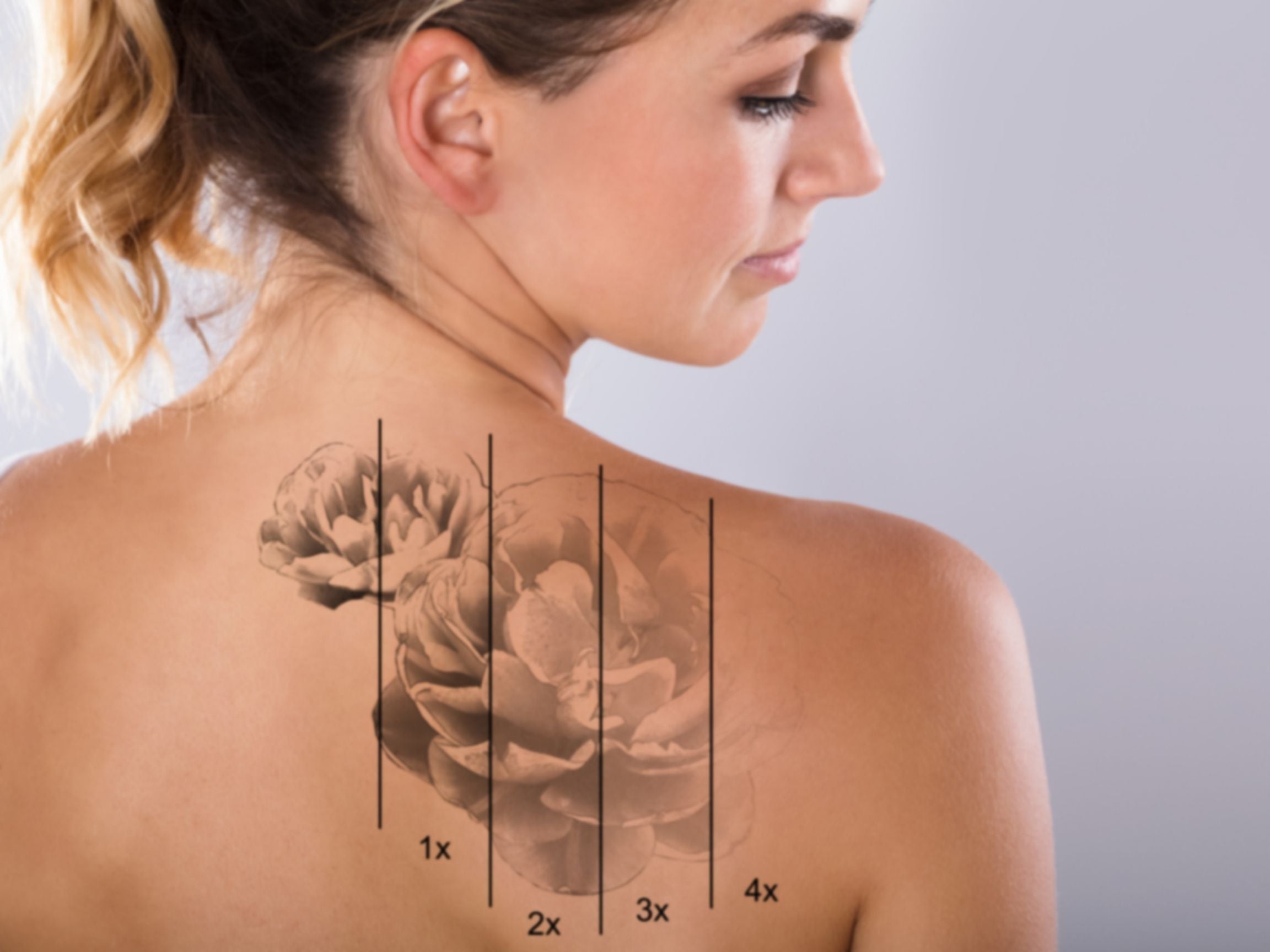 Fade the Past: Laser Tattoo Removal in Mississauga, Oakville & Burlington