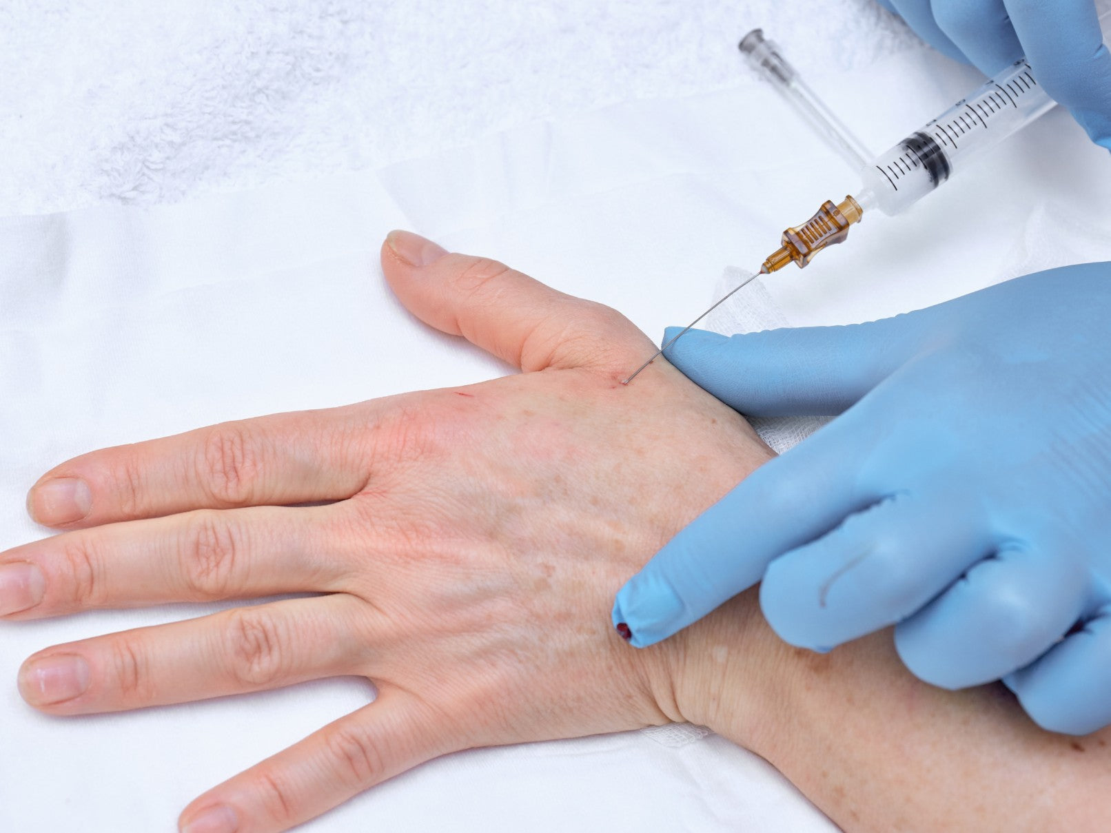 Restore Youthful Hands: Hand Rejuvenation with Cosmetic Fillers