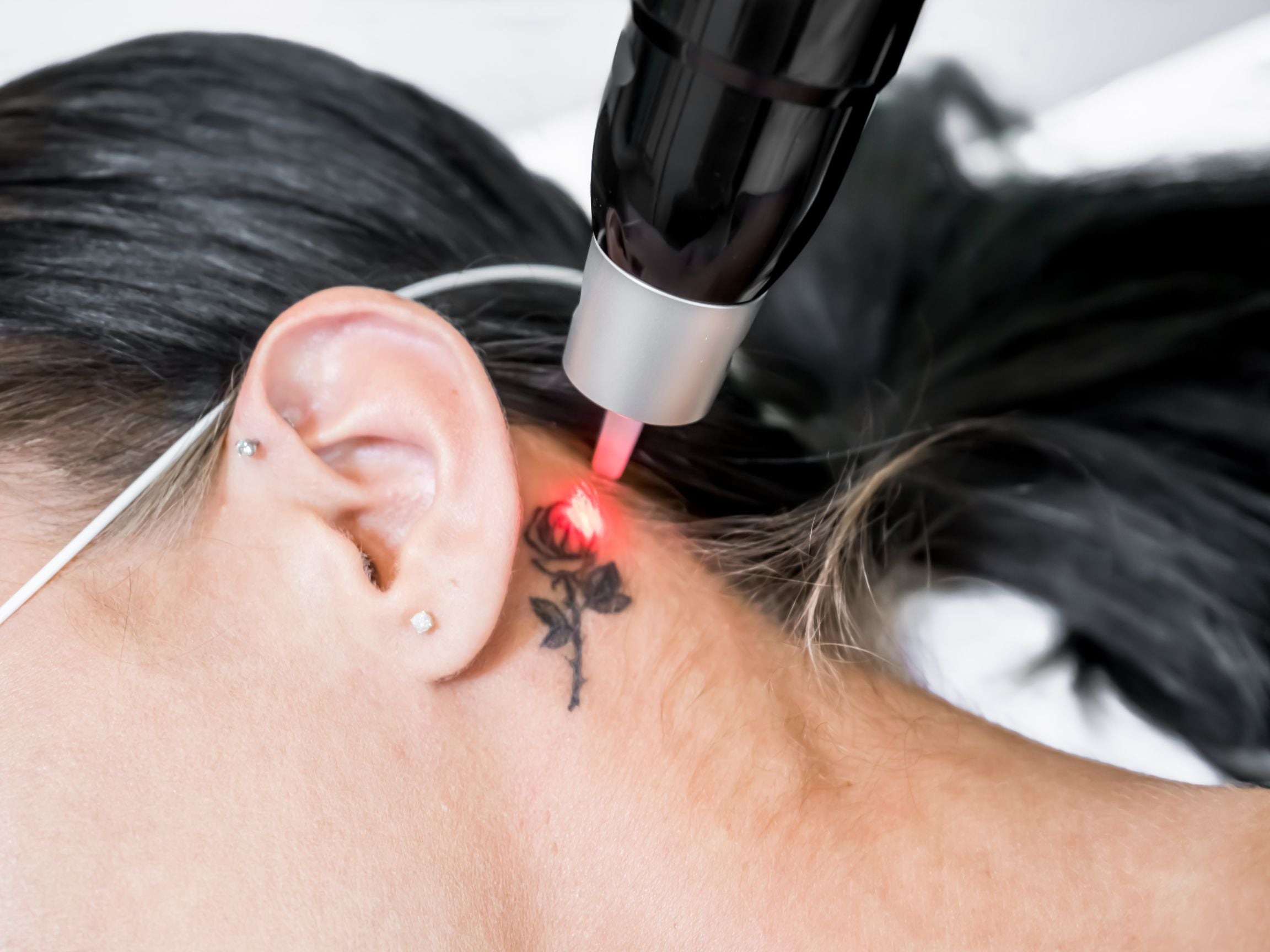 Safe, Effective Tattoo Removal in Mississauga