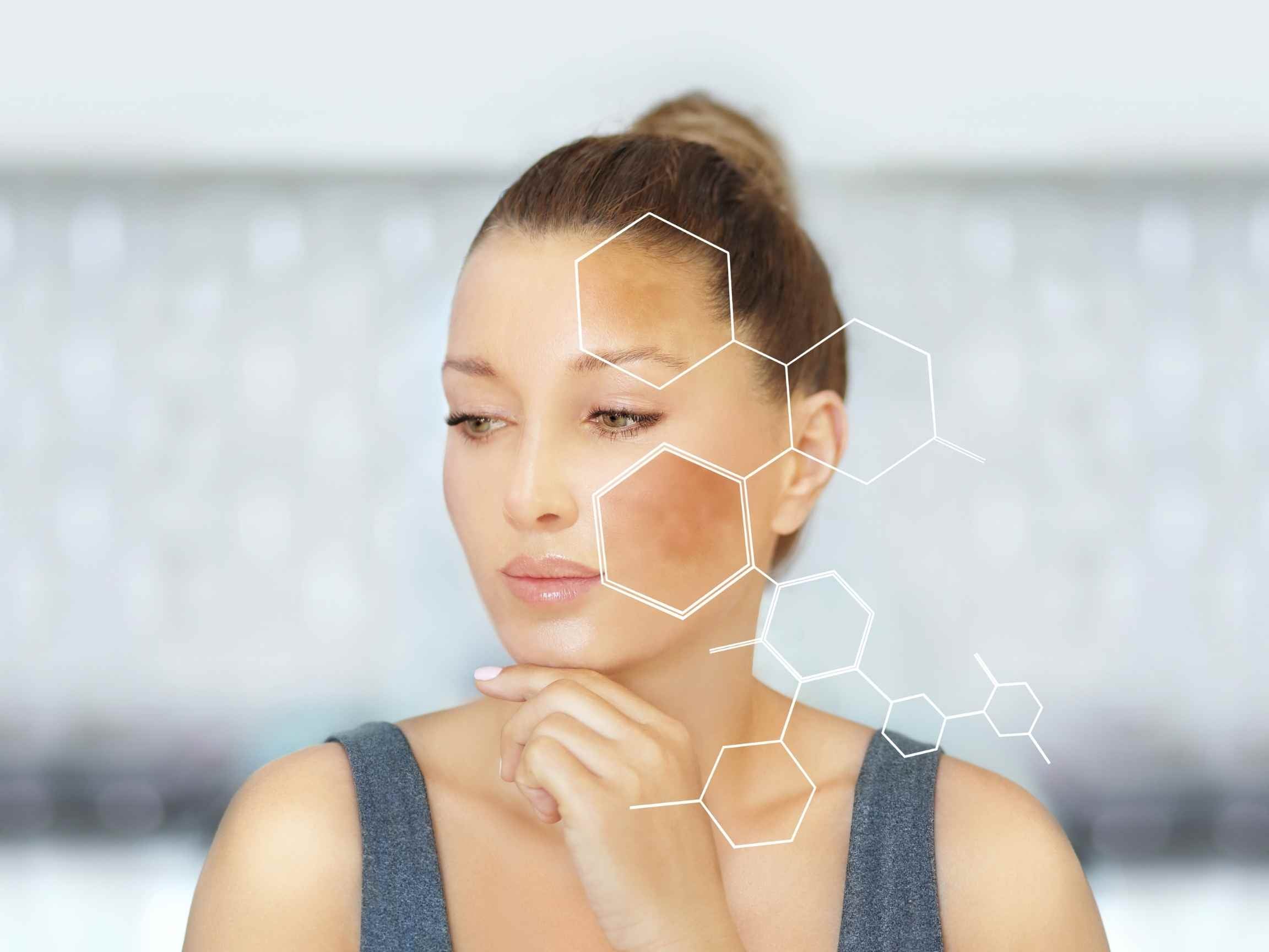 Sol Skin Spa's Guide to Treating Melasma & Hyperpigmentation Safely