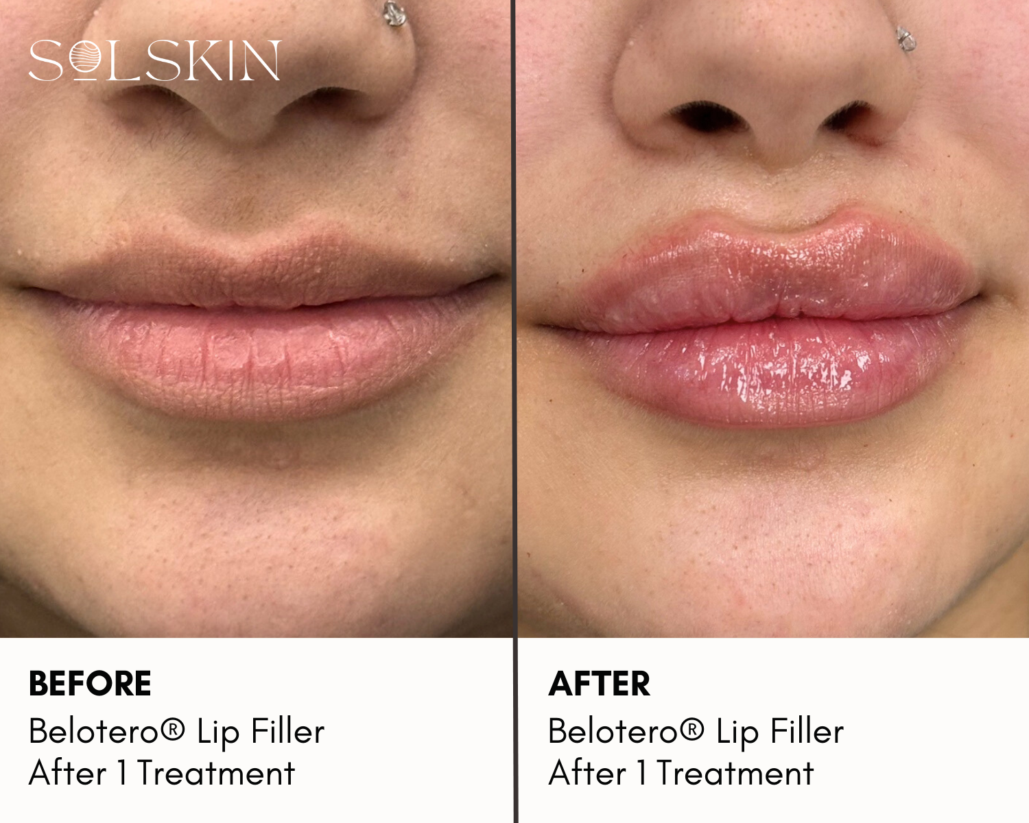 Belotero® Lip Filler (2).png__PID:4be17d45-1211-4db7-8739-ccdaad7e4c06