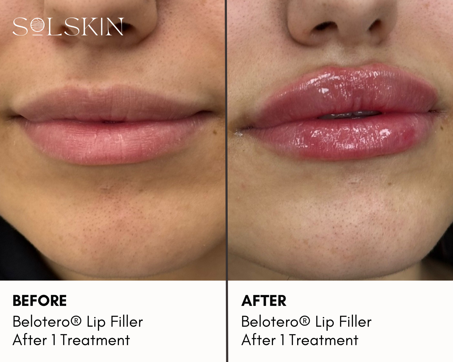 Belotero® Lip Filler (3).png__PID:e17d4512-116d-4787-b9cc-daad7e4c060b