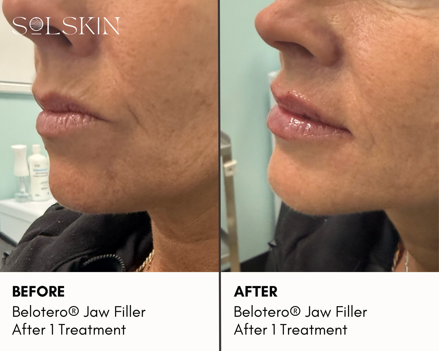 Belotero® Lip Filler (5).png__PID:4512116d-b787-49cc-9aad-7e4c060b5baa