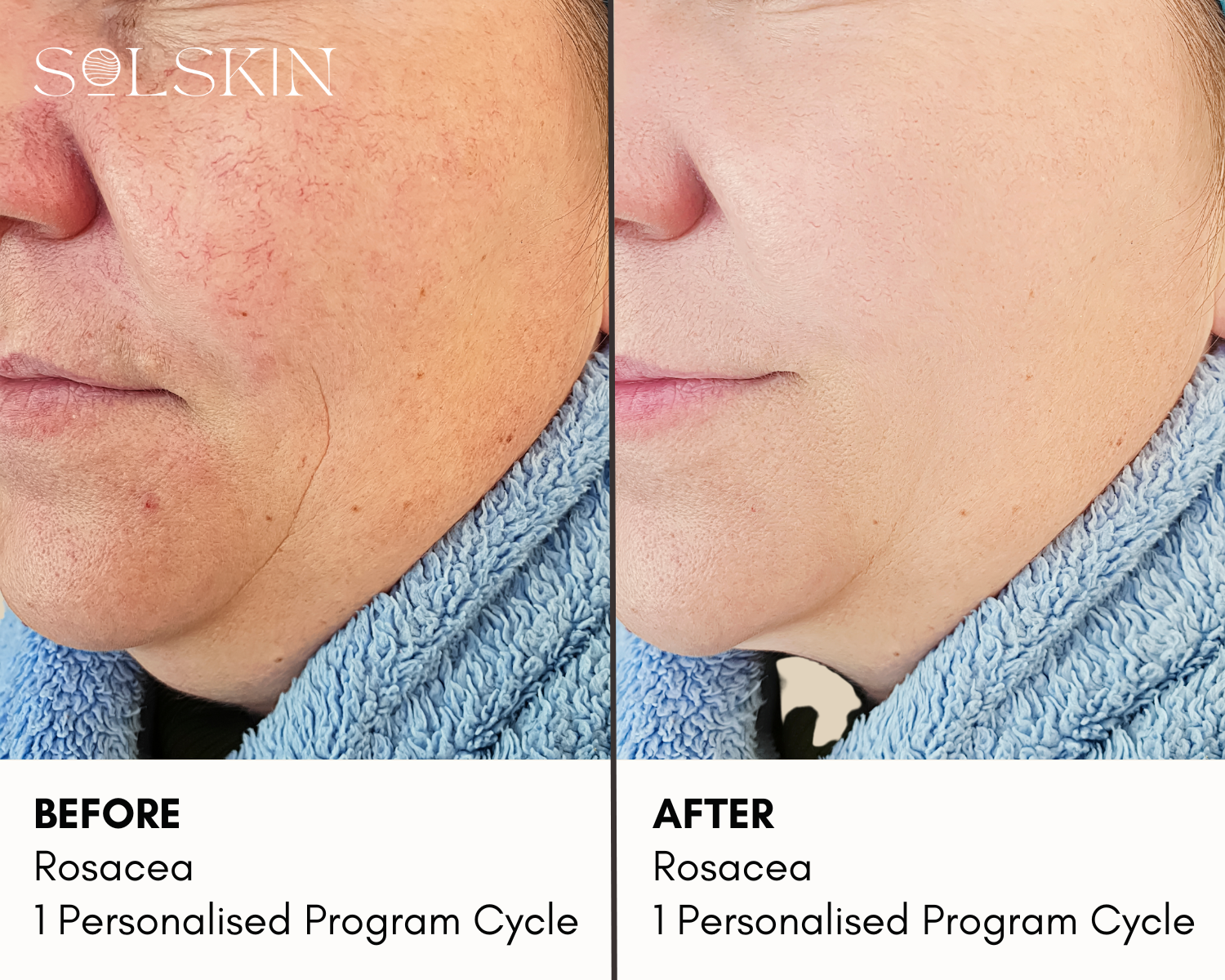 Clarity II Laser for Rosacea (2).png__PID:e13efea7-da27-433c-aa34-17c2a5f1435c