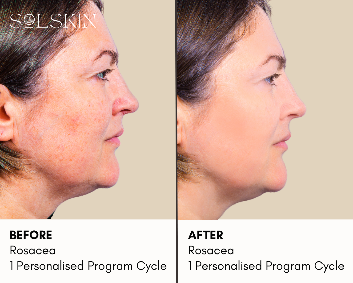 Clarity II Laser for Rosacea.png__PID:3efea7da-2793-4c6a-b417-c2a5f1435cdb