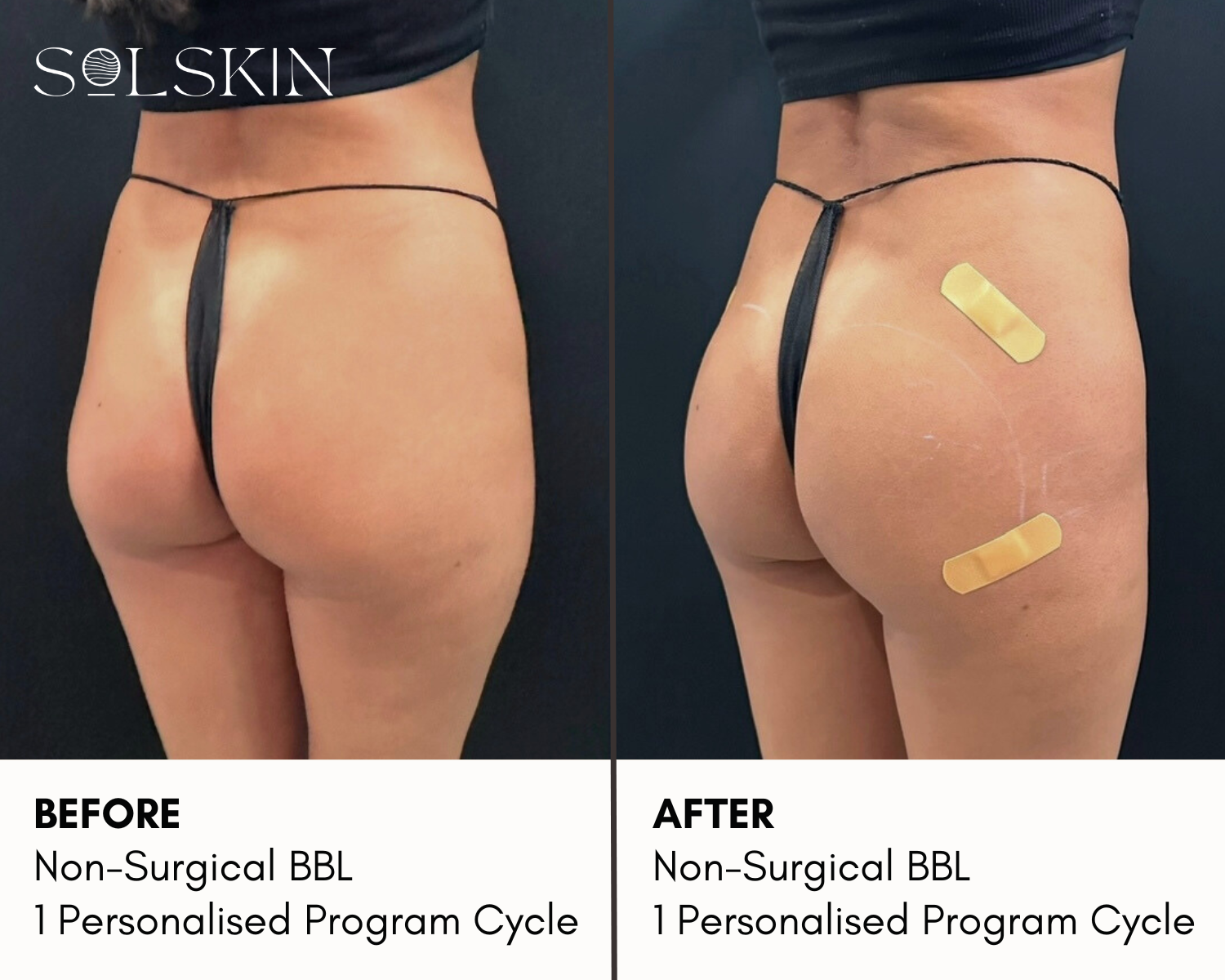 Non-Surgical BBL.png__PID:b78739cc-daad-4e4c-860b-5baab4e16813