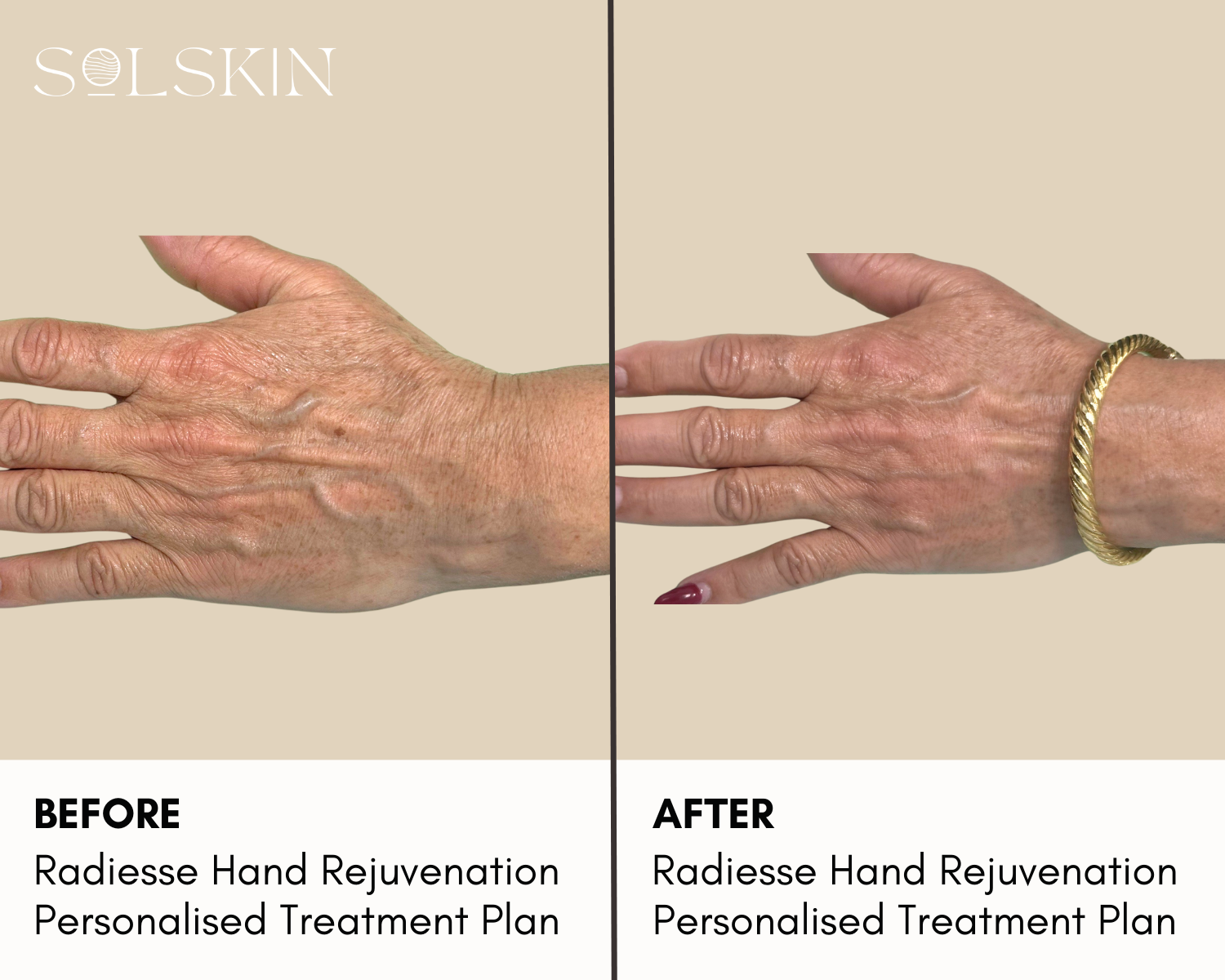 Radiesse Hand Rejuvenation (2).png__PID:ccdaad7e-4c06-4b5b-aab4-e168134fd88a