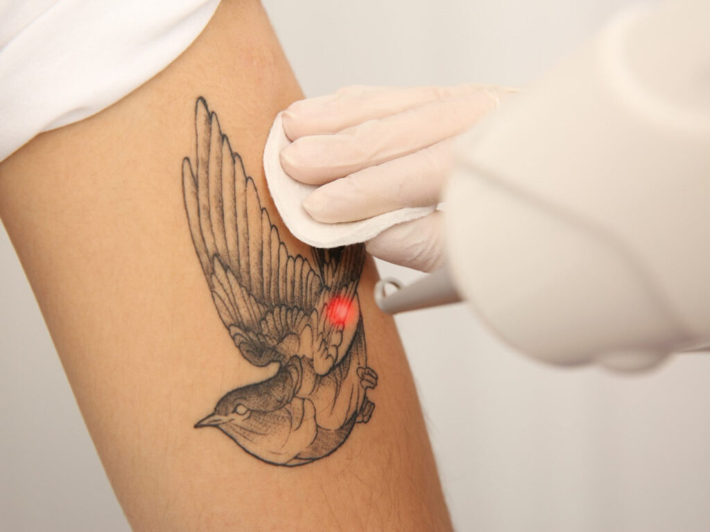 Laser_Tattoo_Removal_-_Sol_Skin_Spa
