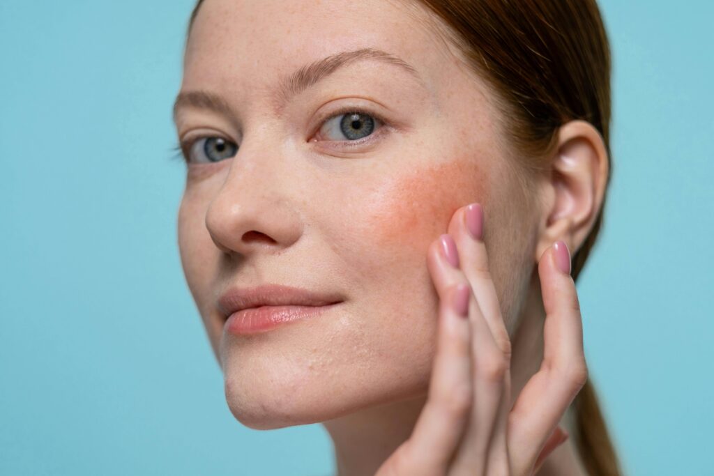 rosacea treatment-women's health clinic - SOL SKIN Dermatology Treatments