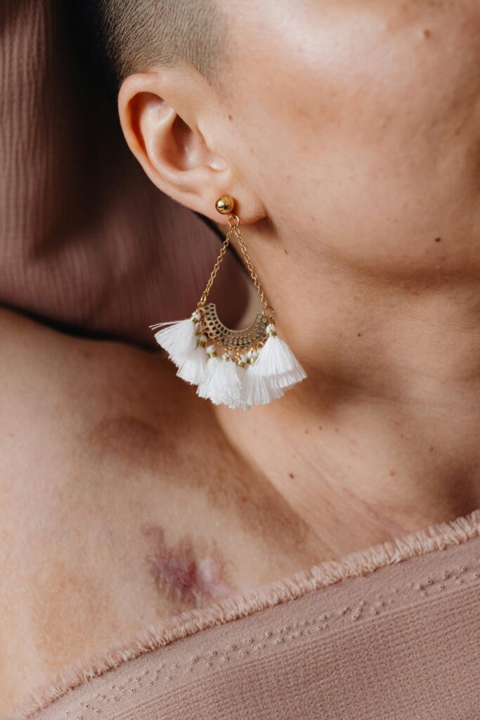 Hidradenitis Suppurativa (HS)- women's health clinic - SOL SKIN Dermatology Treatments