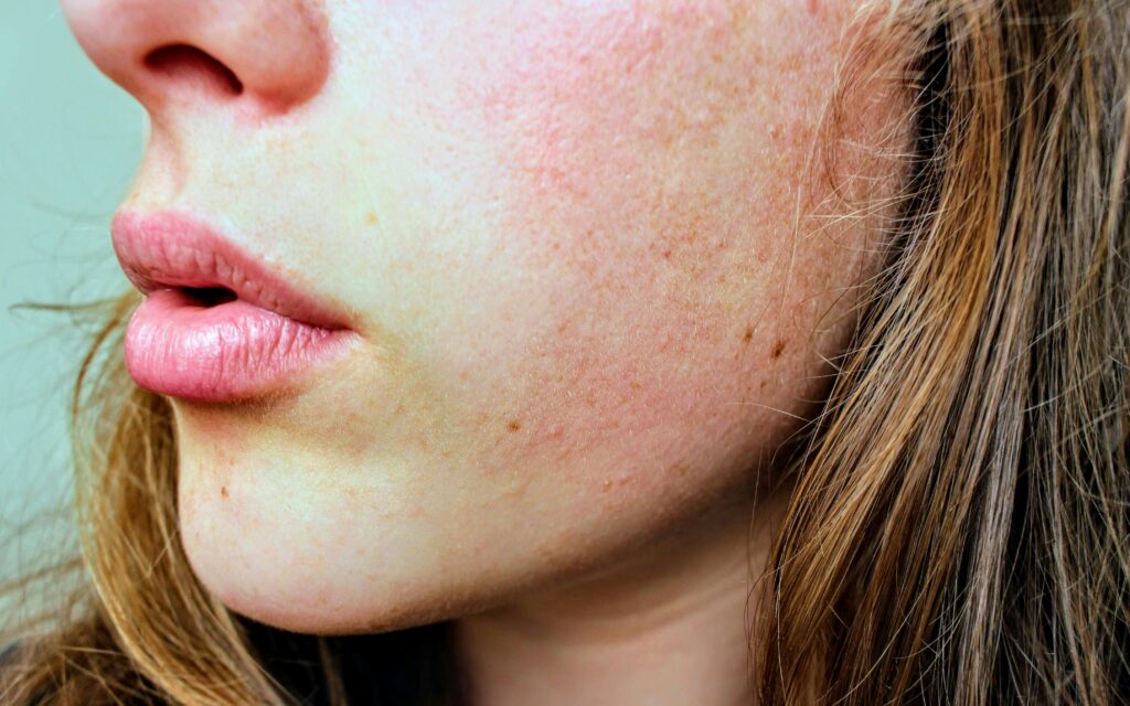 eczema treatment-women's health clinic - SOL SKIN Dermatology Treatments
