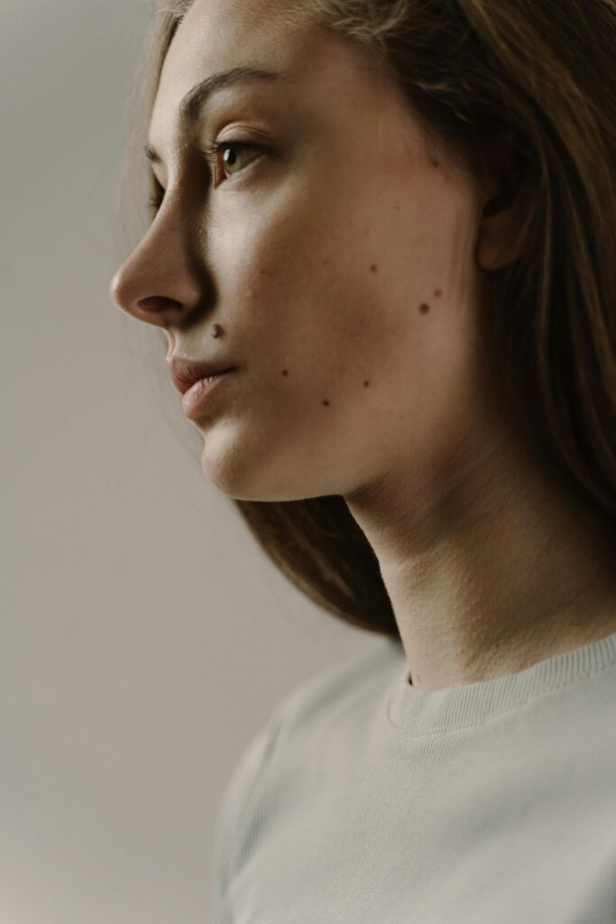 moles treatment -women's health clinic - SOL SKIN Dermatology Treatments