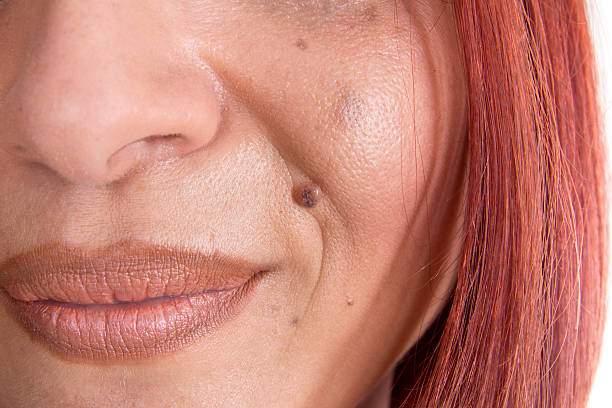 Skin tag-women's health clinic - SOL SKIN Dermatology Treatments