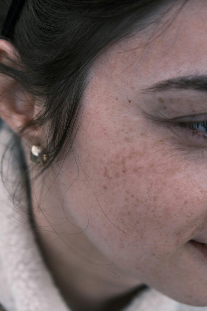 Actinic Keratosis- women's wellness clinic -SOL SKIN Dermatology Treatments
