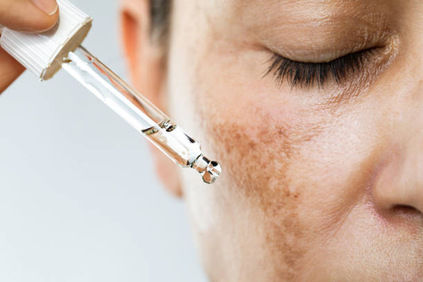 melasma treatment - women's health clinic-SOL SKIN Dermatology Treatments